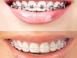 Invisalign – The Clear Alternative to Metal Braces